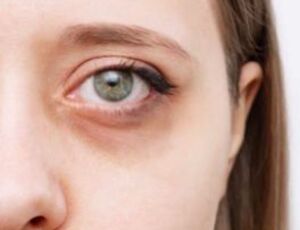 Conheça as 6 principais causas de olheiras