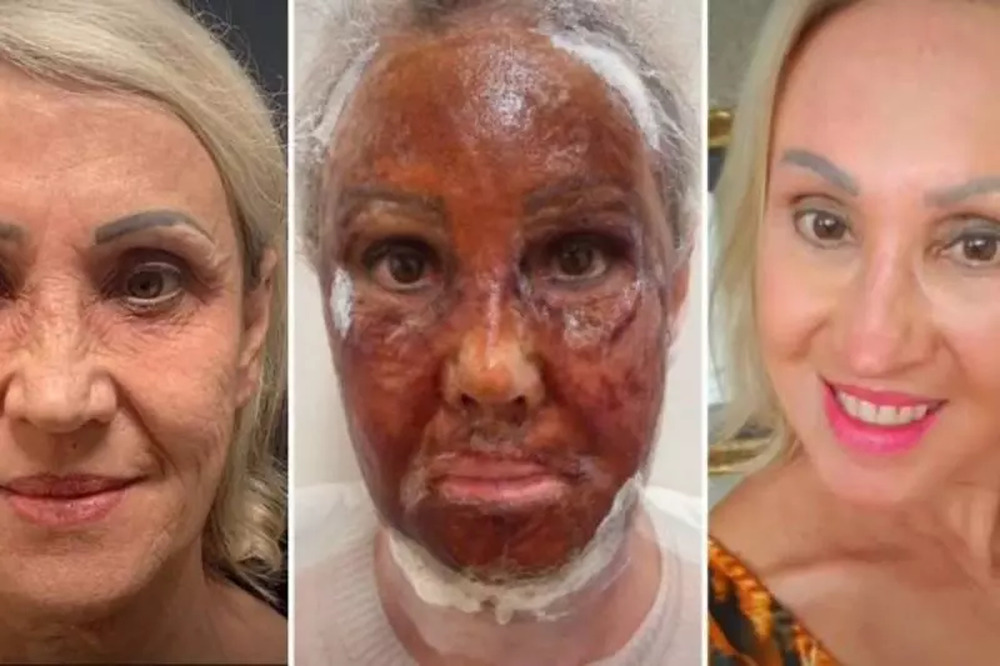 Peeling de fenol: saiba o que é e quais cuidados devem ser tomados