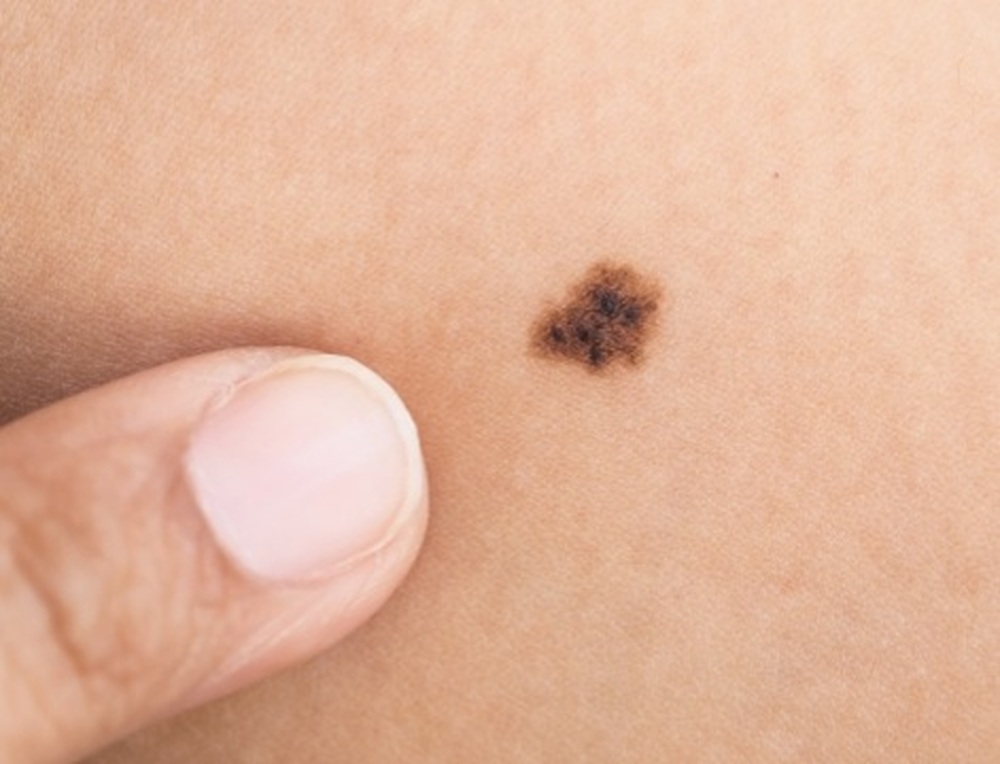 Melanoma: um sinal de alerta! 