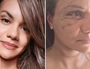 Agredida com 61 socos por ex-jogador mostra rosto dias após cirurgia