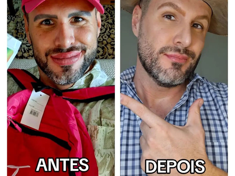 Bernardo Langlott reverte procedimentos e gera debate sobre excessos na aparência: 