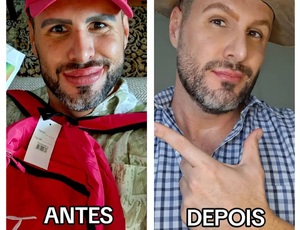 Bernardo Langlott reverte procedimentos e gera debate sobre excessos na aparência: 