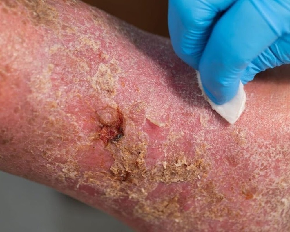 Mês dos idosos: Diabetes e doenças vasculares elevam riscos de amputação de pernas e pés