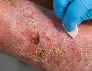 Mês dos idosos: Diabetes e doenças vasculares elevam riscos de amputação de pernas e pés
