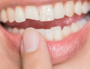 Quebrou o dente? O que fazer nos primeiros minutos para salvar o sorriso?