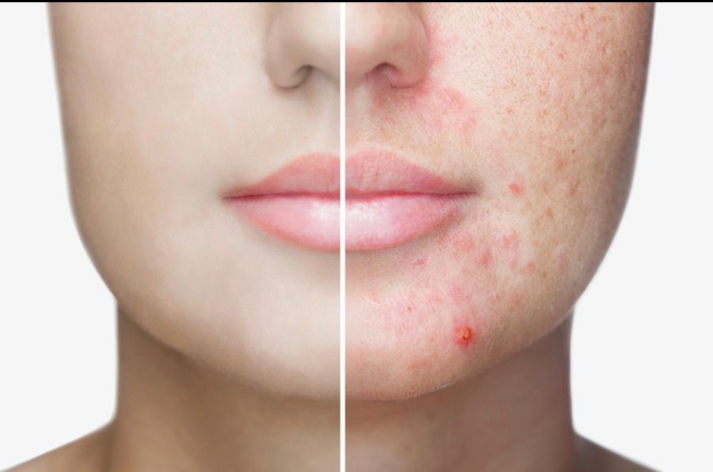 Acne adulta: quando a pele reflete o estresse