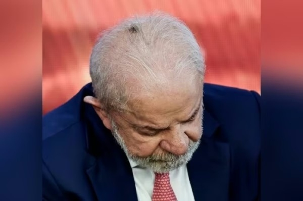 Lula remove lesão causada por carcinoma basocelular; entenda este tipo de câncer de pele