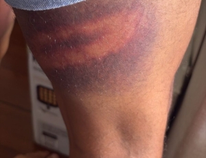 Vereador Rick Azevedo leva porrada de policiais militares e registra queixa de agressão contra a PM