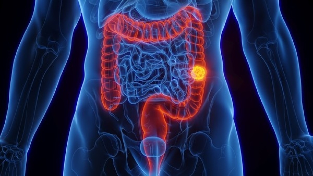 Ministério da Saúde amplia prevenção ao câncer de intestino com novo exame no SUS