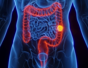 Ministério da Saúde amplia prevenção ao câncer de intestino com novo exame no SUS