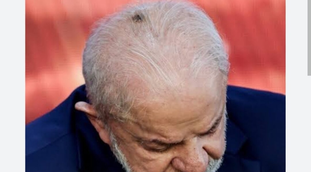 Lula passa por radioterapia no couro cabeludo