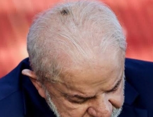Lula passa por radioterapia no couro cabeludo