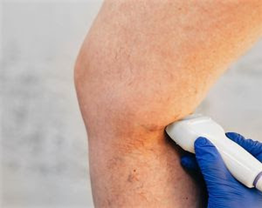 Sintomas e tratamento das varizes: quando a cirurgia é necessária?