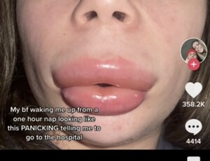 Norte-americana viraliza no TikTok ao mostrar inchaço da boca semelhante ao bico de pato após preenchimento labial  